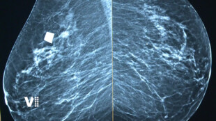 V Jičíně dál funguje mamograf